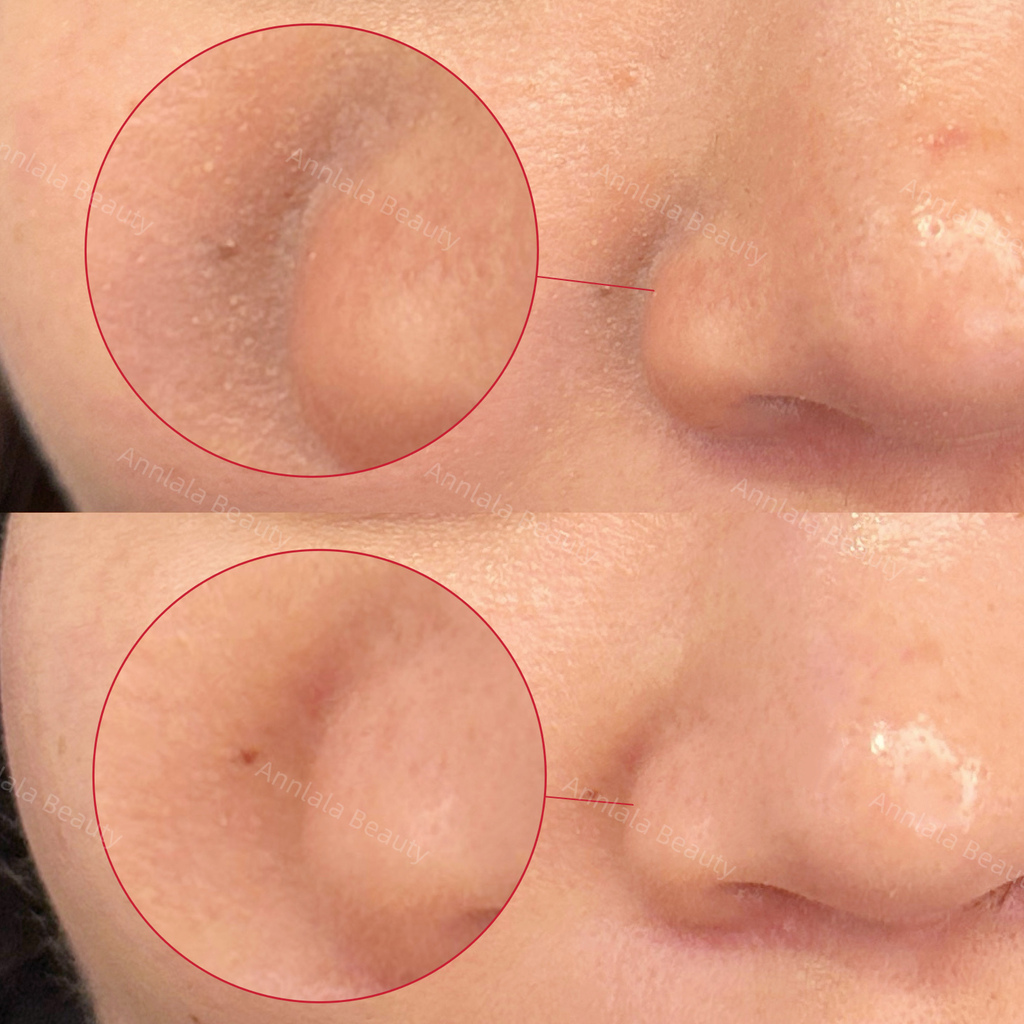 Annlala Beauty 水飛梭保濕課程 - 粉刺.JPG