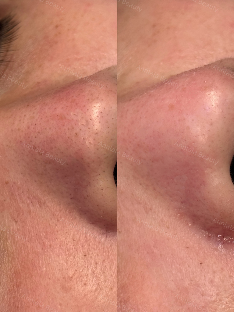 Annlala Beauty 水飛梭 男生臉部保養｜除粉刺.JPG