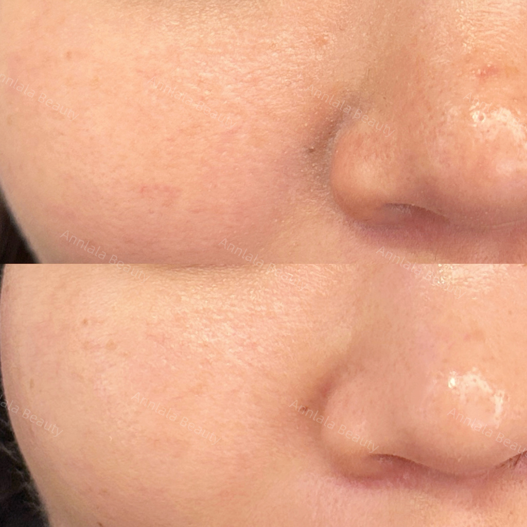 Annlala Beauty 水飛梭保水課程 (1).JPG