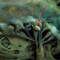 Verrucous endocarditis in a case of TB - tumor