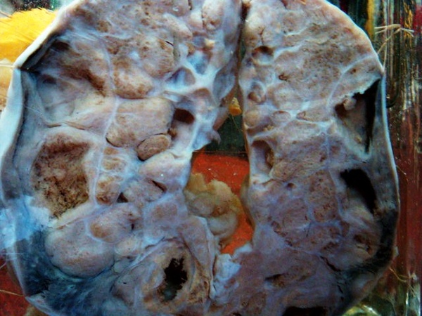 Splenic metastasis of ovarian carcinoma - near