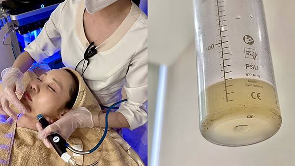 奈思診所 | 我去體驗了最近很紅的水飛梭「海菲秀」療程過程+