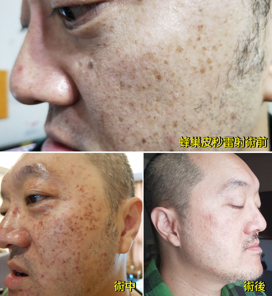 嘉義醫學美容 台南雷射除斑 郭健軍皮膚科診所 超驚人實測 蜂巢皮秒雷射 圓了一個除雀斑的夢 艾瑪娘的小日子