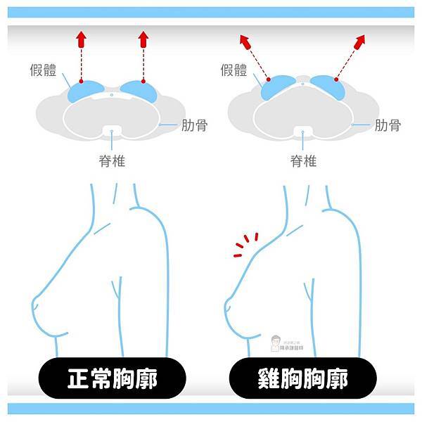 隆乳不容易有乳溝，可能是雞胸或胸骨太凸出有關