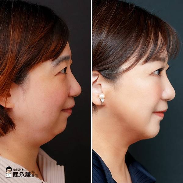 天鵝頸手術改善了雙下巴、墊下巴將側臉下顎輪廓線也變俐落了-20240321.jpg