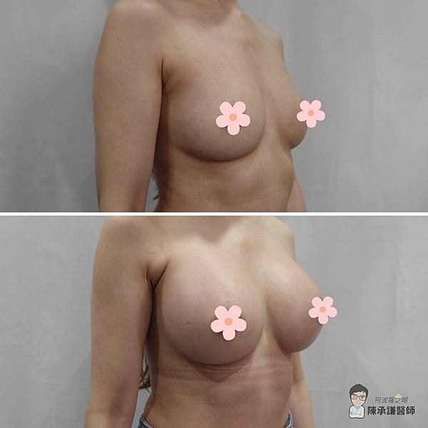 珍珠波隆乳後從B罩杯升級到G罩杯