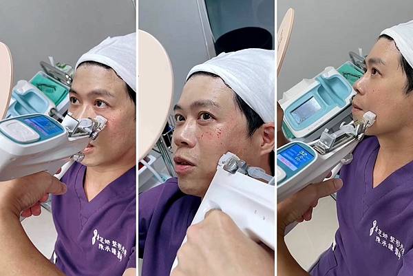 陳承謙醫師接受中胚層療法自己施打水光槍注入真皮層 陳承謙醫師接受中胚層療法自己施打水光槍注入真皮層