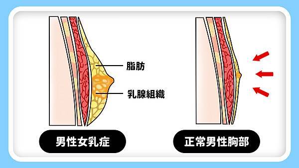 男性女乳症因乳腺組織增生而出現激凸、胸部變大的現象 男性女乳症因乳腺組織增生而出現激凸、胸部變大的現象