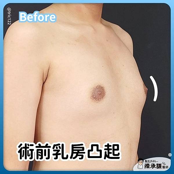 男性女乳症術前乳房凸起,穿衣容易激凸-20250929.jpg 男性女乳症術前乳房凸起,穿衣容易激凸-20250929.jpg