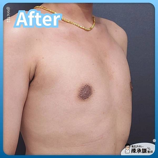 男性女乳症手術解決穿衣乳頭激凸的問題-20250929.jpg 男性女乳症手術解決穿衣乳頭激凸的問題-20250929.jpg