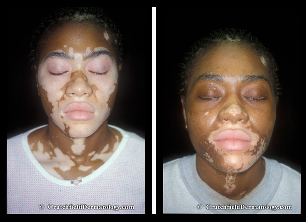 001_vitiligo_powell_L.jpg