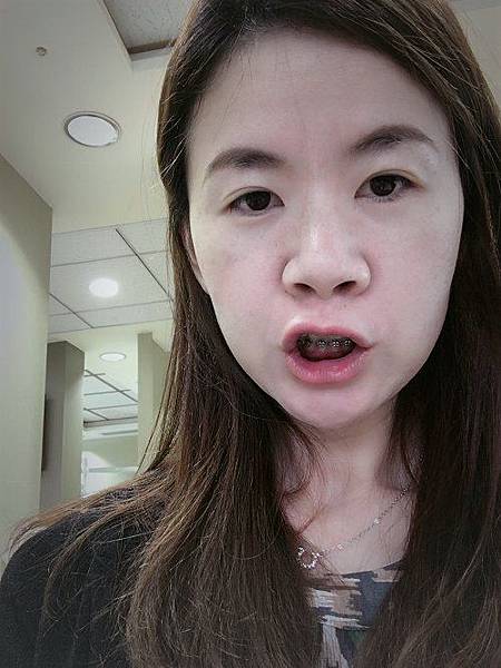 2016-05-21第一次裝骨釘 2016-05-21第一次裝骨釘