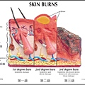 燒燙傷4.jpg