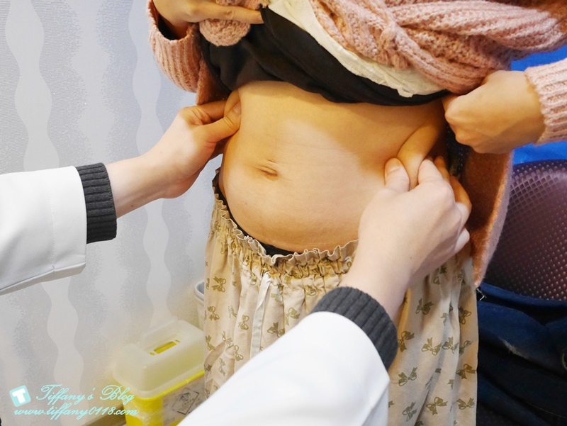 VASER威塑抽脂體驗 - 『醫美‧腹部』威塑抽脂3個月成果!!3.jpg VASER威塑抽脂體驗 - 『醫美‧腹部』威塑抽脂3個月成果!!3.jpg