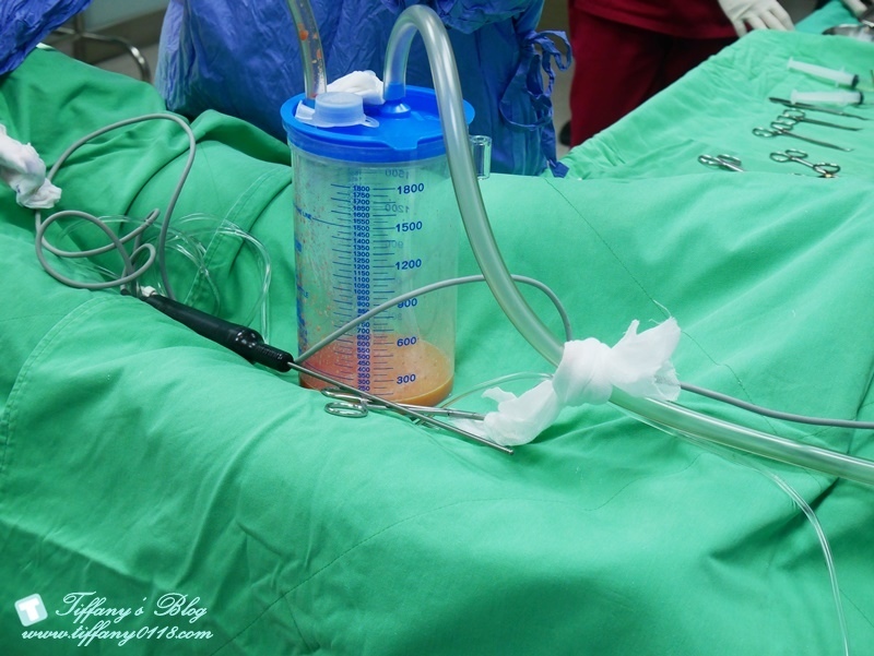 VASER威塑抽脂體驗 - 『醫美‧腹部』威塑抽脂3個月成果!!11.jpg VASER威塑抽脂體驗 - 『醫美‧腹部』威塑抽脂3個月成果!!11.jpg