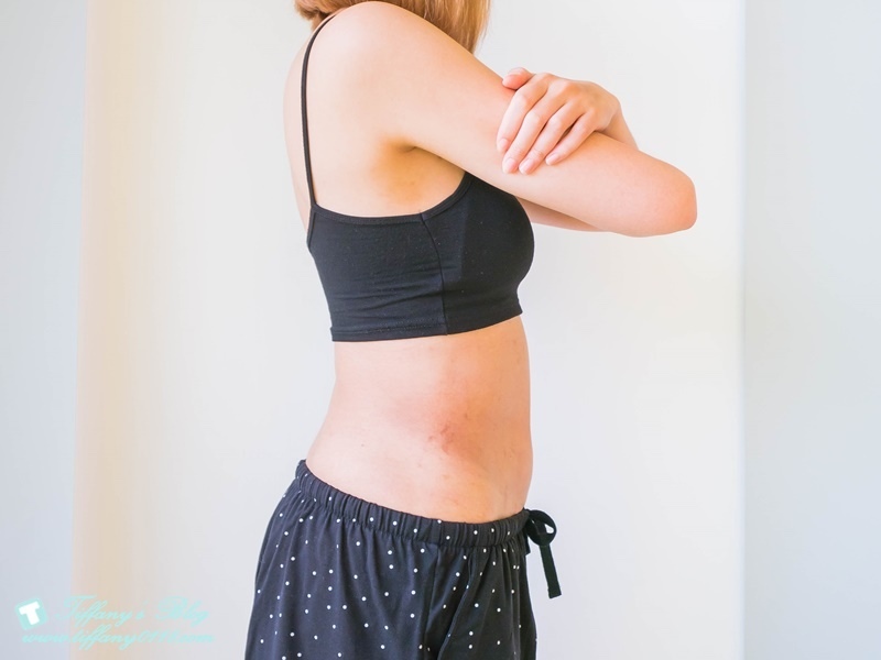 VASER威塑抽脂體驗 - 『醫美‧腹部』威塑抽脂3個月成果!!31.jpg VASER威塑抽脂體驗 - 『醫美‧腹部』威塑抽脂3個月成果!!31.jpg