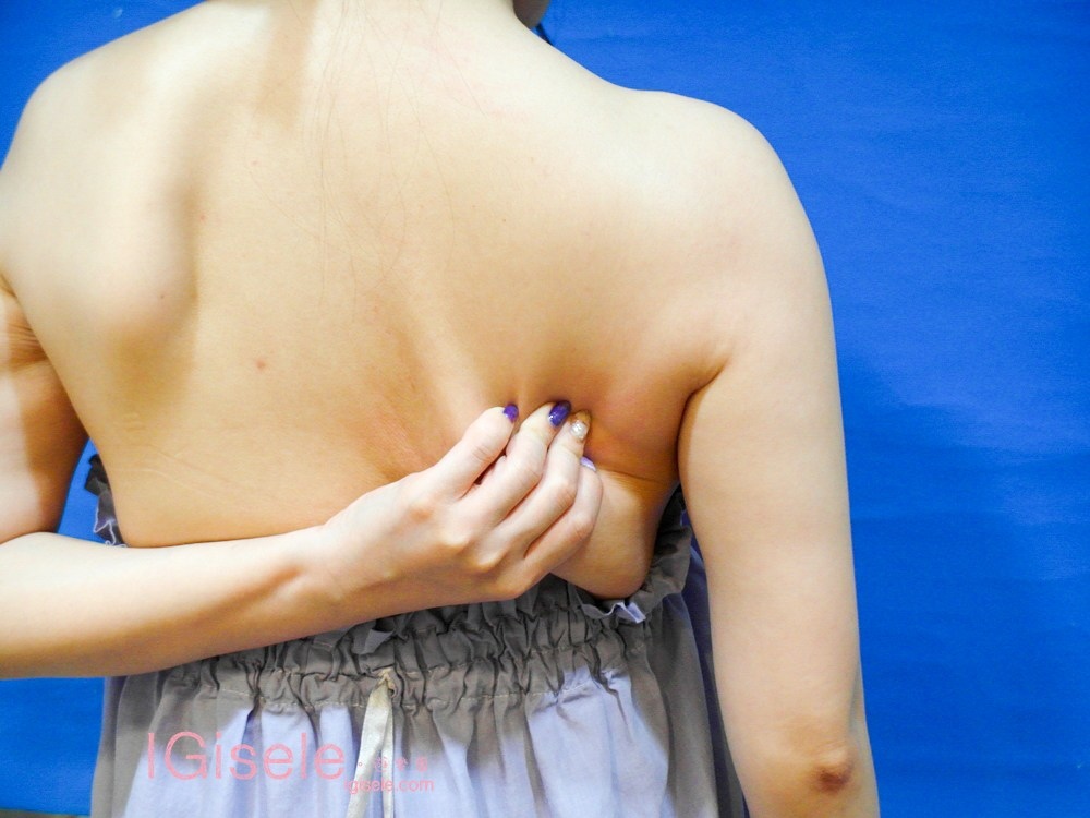 威塑超音波抽脂 - 悄悄的做了威塑瘦手臂跟背 術後五個月心得分享3.jpg 威塑超音波抽脂 - 悄悄的做了威塑瘦手臂跟背 術後五個月心得分享3.jpg