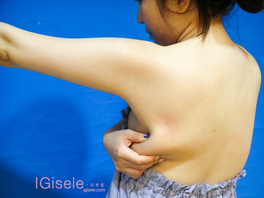 威塑超音波抽脂 - 悄悄的做了威塑瘦手臂跟背 術後五個月心得分享5.jpg 威塑超音波抽脂 - 悄悄的做了威塑瘦手臂跟背 術後五個月心得分享5.jpg