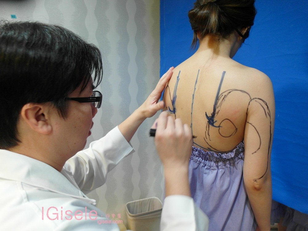 威塑超音波抽脂 - 悄悄的做了威塑瘦手臂跟背 術後五個月心得分享6.jpg 威塑超音波抽脂 - 悄悄的做了威塑瘦手臂跟背 術後五個月心得分享6.jpg