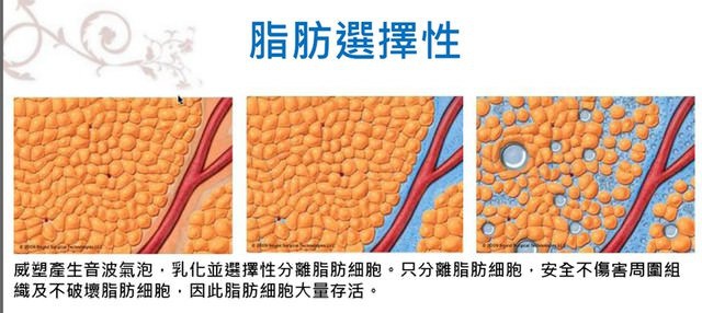 威塑超音波抽脂 - 悄悄的做了威塑瘦手臂跟背 術後五個月心得分享10.jpg