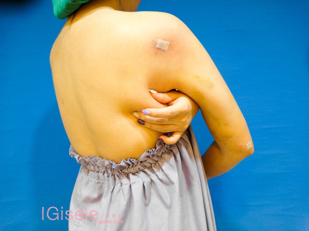 威塑超音波抽脂 - 悄悄的做了威塑瘦手臂跟背 術後五個月心得分享17.jpg 威塑超音波抽脂 - 悄悄的做了威塑瘦手臂跟背 術後五個月心得分享17.jpg