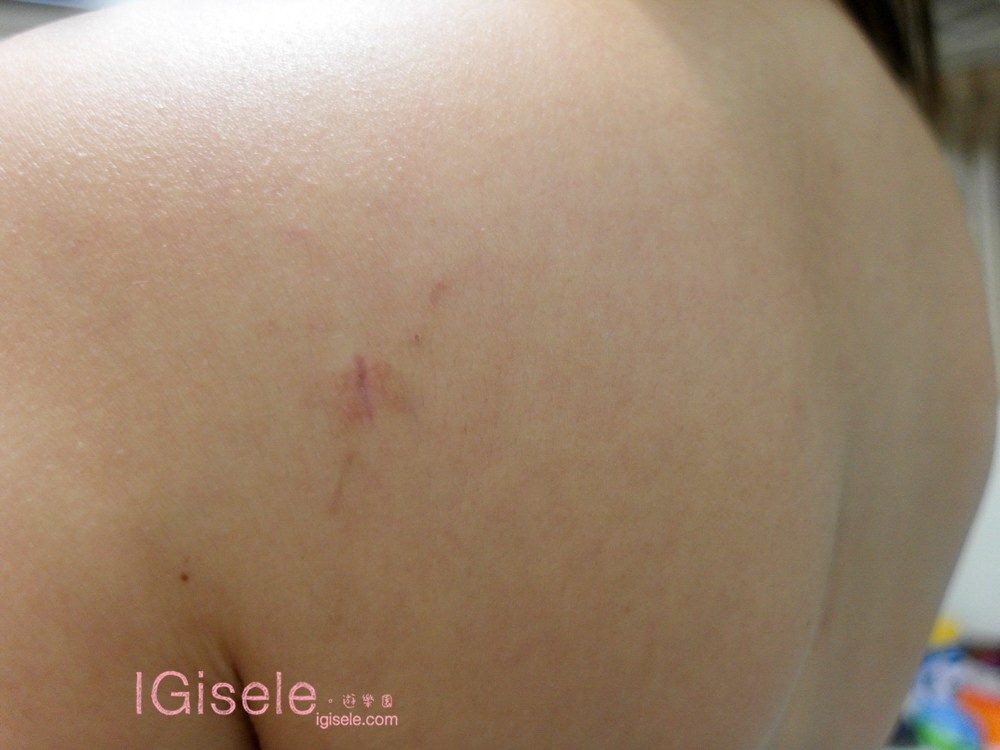 威塑超音波抽脂 - 悄悄的做了威塑瘦手臂跟背 術後五個月心得分享18.jpg 威塑超音波抽脂 - 悄悄的做了威塑瘦手臂跟背 術後五個月心得分享18.jpg