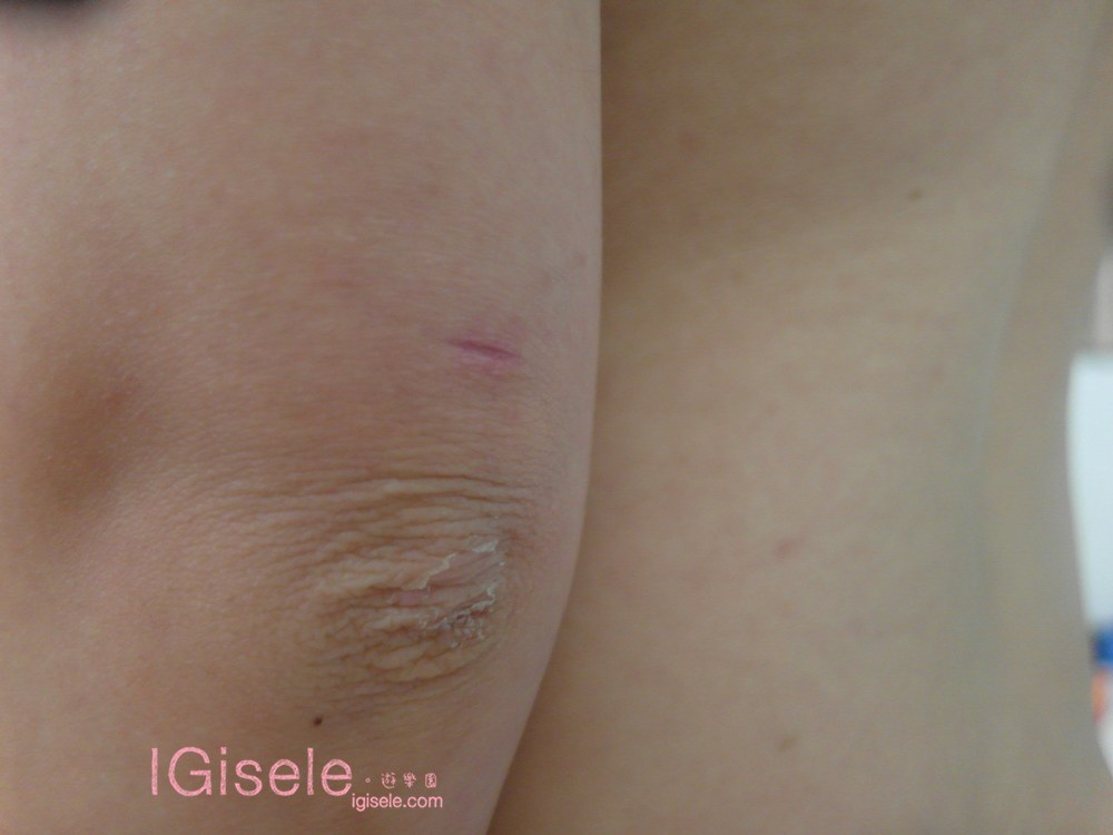 威塑超音波抽脂 - 悄悄的做了威塑瘦手臂跟背 術後五個月心得分享19.jpg 威塑超音波抽脂 - 悄悄的做了威塑瘦手臂跟背 術後五個月心得分享19.jpg