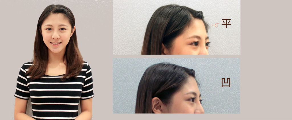 玻尿酸體驗 - 美女【喬言愛】Hyadermis海德密絲豐額5.jpg 玻尿酸體驗 - 美女【喬言愛】Hyadermis海德密絲豐額5.jpg