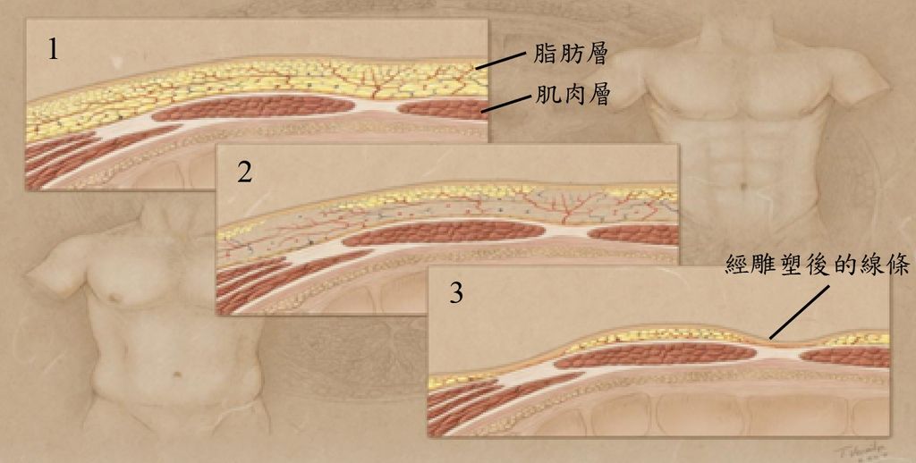 威塑抽脂.jpg