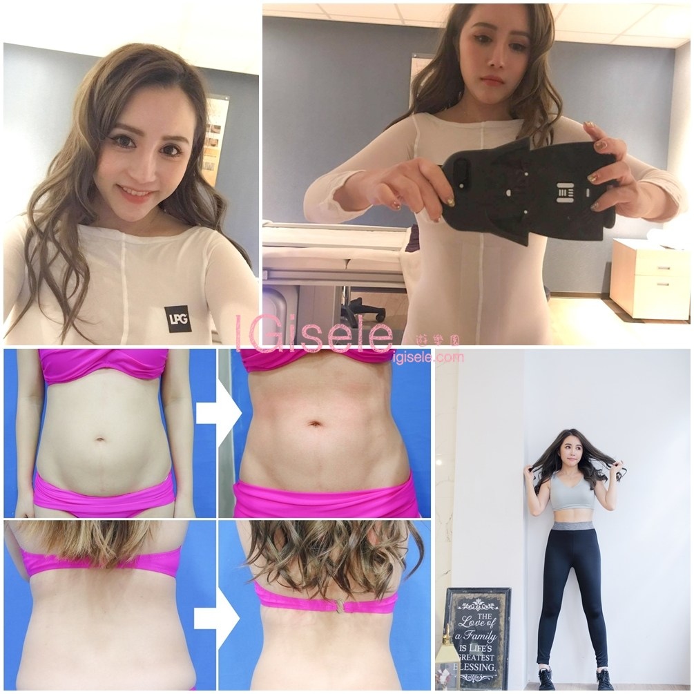 威塑超音波抽脂分享 - 悄悄的做了威塑VASER腹部環抽。術後心得分享.jpg 威塑超音波抽脂分享 - 悄悄的做了威塑VASER腹部環抽。術後心得分享.jpg