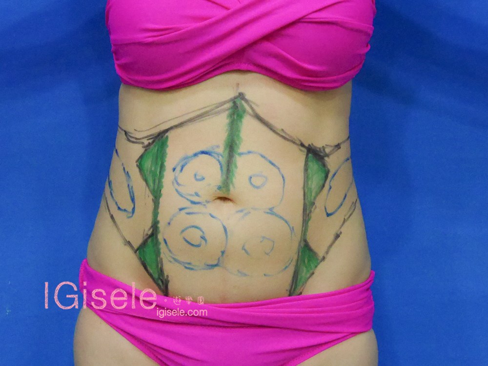 威塑超音波抽脂分享 - 悄悄的做了威塑VASER腹部環抽。術後心得分享7.jpg 威塑超音波抽脂分享 - 悄悄的做了威塑VASER腹部環抽。術後心得分享7.jpg
