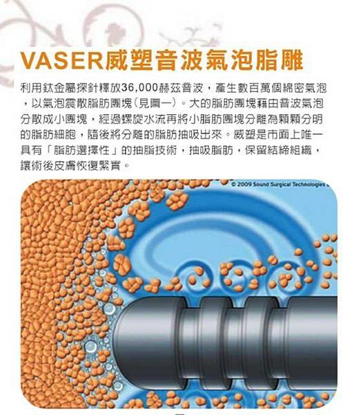威塑超音波抽脂分享 - 悄悄的做了威塑VASER腹部環抽。術後心得分享12.jpg