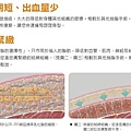 威塑超音波抽脂分享 - 悄悄的做了威塑VASER腹部環抽。術後心得分享13.jpg