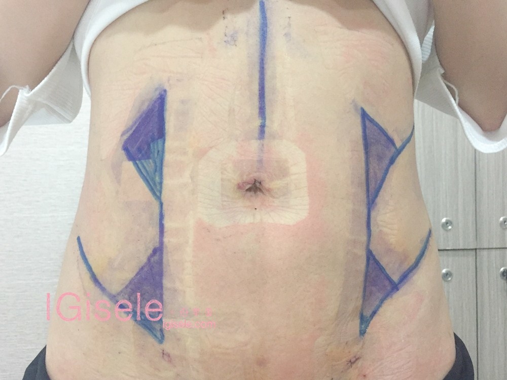 威塑超音波抽脂分享 - 悄悄的做了威塑VASER腹部環抽。術後心得分享14.jpg 威塑超音波抽脂分享 - 悄悄的做了威塑VASER腹部環抽。術後心得分享14.jpg