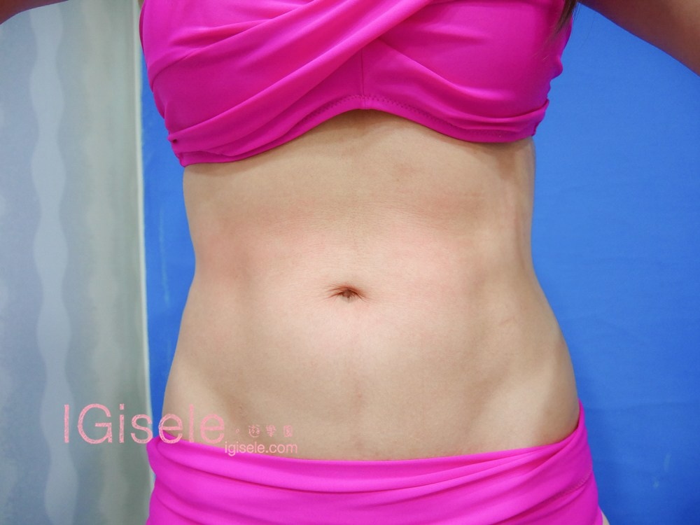 威塑超音波抽脂分享 - 悄悄的做了威塑VASER腹部環抽。術後心得分享24.jpg 威塑超音波抽脂分享 - 悄悄的做了威塑VASER腹部環抽。術後心得分享24.jpg