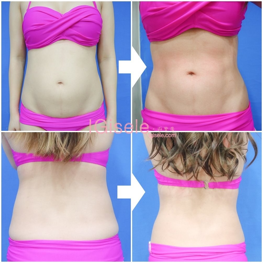 威塑超音波抽脂分享 - 悄悄的做了威塑VASER腹部環抽。術後心得分享28.jpg 威塑超音波抽脂分享 - 悄悄的做了威塑VASER腹部環抽。術後心得分享28.jpg