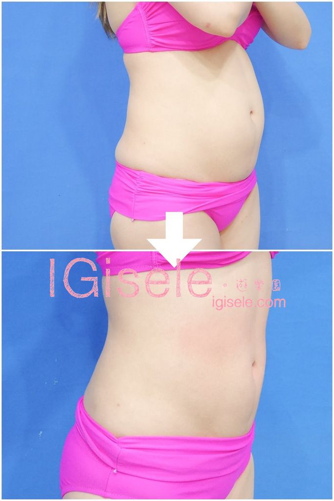威塑超音波抽脂分享 - 悄悄的做了威塑VASER腹部環抽。術後心得分享29.jpg 威塑超音波抽脂分享 - 悄悄的做了威塑VASER腹部環抽。術後心得分享29.jpg