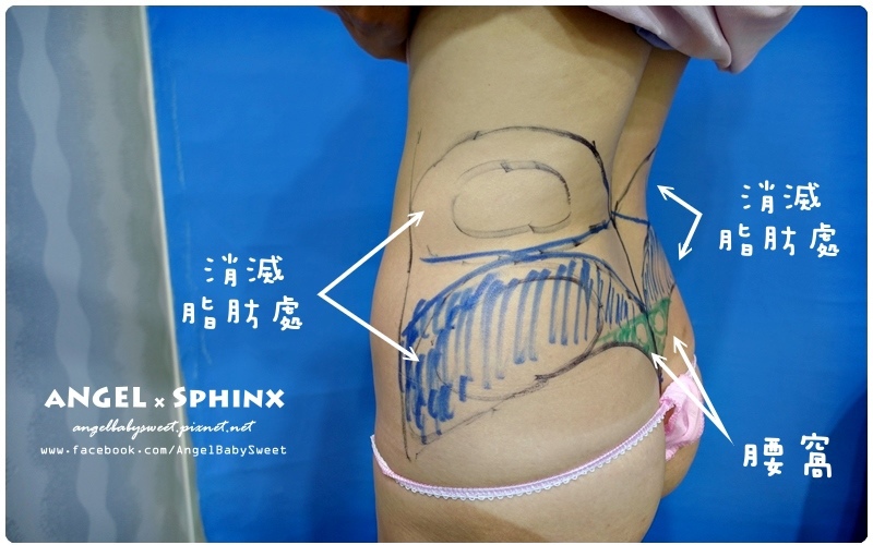 威塑超音波抽脂分享 - VASER威塑抽脂告別愛的把手馬鞍肉&雕塑腰窩 + 自體脂肪填補13.jpg 威塑超音波抽脂分享 - VASER威塑抽脂告別愛的把手馬鞍肉&雕塑腰窩 + 自體脂肪填補13.jpg