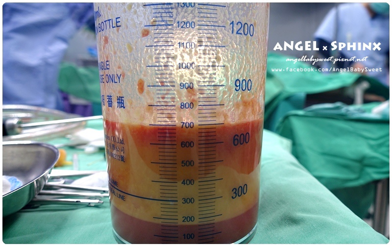 威塑超音波抽脂分享 - VASER威塑抽脂告別愛的把手馬鞍肉&雕塑腰窩 + 自體脂肪填補17.jpg 威塑超音波抽脂分享 - VASER威塑抽脂告別愛的把手馬鞍肉&雕塑腰窩 + 自體脂肪填補17.jpg