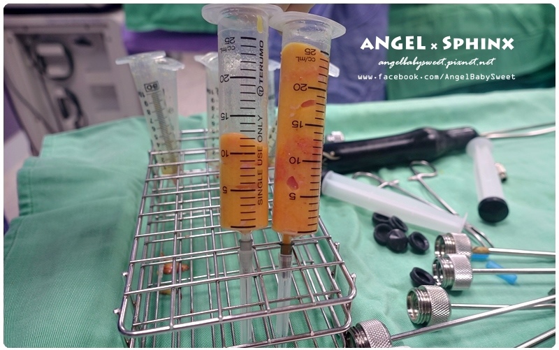 威塑超音波抽脂分享 - VASER威塑抽脂告別愛的把手馬鞍肉&雕塑腰窩 + 自體脂肪填補18.jpg 威塑超音波抽脂分享 - VASER威塑抽脂告別愛的把手馬鞍肉&雕塑腰窩 + 自體脂肪填補18.jpg