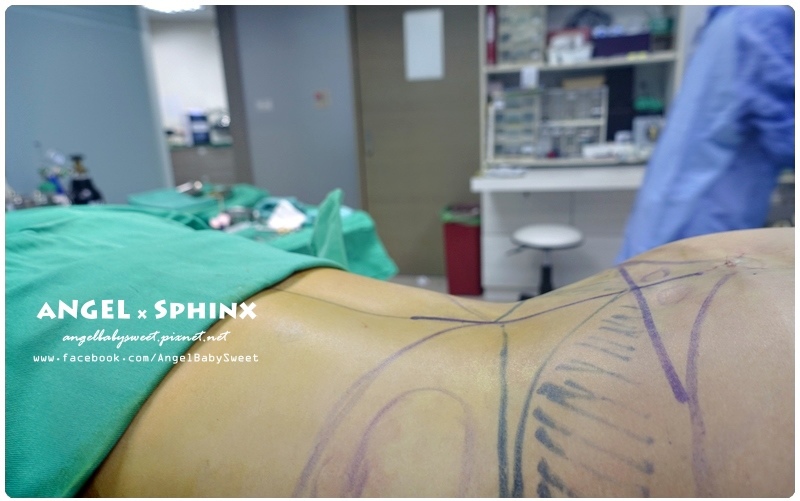 威塑超音波抽脂分享 - VASER威塑抽脂告別愛的把手馬鞍肉&雕塑腰窩 + 自體脂肪填補19.jpg 威塑超音波抽脂分享 - VASER威塑抽脂告別愛的把手馬鞍肉&雕塑腰窩 + 自體脂肪填補19.jpg