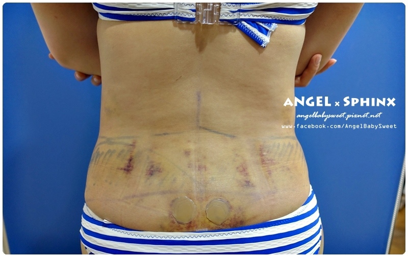 威塑超音波抽脂分享 - VASER威塑抽脂告別愛的把手馬鞍肉&雕塑腰窩 + 自體脂肪填補25.jpg 威塑超音波抽脂分享 - VASER威塑抽脂告別愛的把手馬鞍肉&雕塑腰窩 + 自體脂肪填補25.jpg