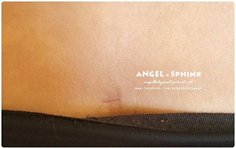 威塑超音波抽脂分享 - VASER威塑抽脂告別愛的把手馬鞍肉&雕塑腰窩 + 自體脂肪填補32.jpg 威塑超音波抽脂分享 - VASER威塑抽脂告別愛的把手馬鞍肉&雕塑腰窩 + 自體脂肪填補32.jpg