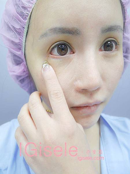 做了電波拉皮+音波拉皮 全臉跟眼週.眼皮鬆弛、法令紋下垂、雙下巴的人可以看這篇心得2.jpg 做了電波拉皮+音波拉皮 全臉跟眼週.眼皮鬆弛、法令紋下垂、雙下巴的人可以看這篇心得2.jpg