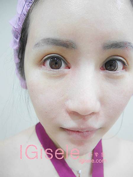 做了電波拉皮+音波拉皮 全臉跟眼週.眼皮鬆弛、法令紋下垂、雙下巴的人可以看這篇心得3.jpg 做了電波拉皮+音波拉皮 全臉跟眼週.眼皮鬆弛、法令紋下垂、雙下巴的人可以看這篇心得3.jpg