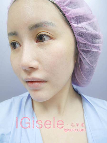 做了電波拉皮+音波拉皮 全臉跟眼週.眼皮鬆弛、法令紋下垂、雙下巴的人可以看這篇心得6.jpg 做了電波拉皮+音波拉皮 全臉跟眼週.眼皮鬆弛、法令紋下垂、雙下巴的人可以看這篇心得6.jpg