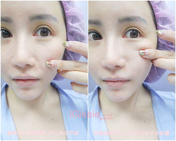 做了電波拉皮+音波拉皮 全臉跟眼週.眼皮鬆弛、法令紋下垂、雙下巴的人可以看這篇心得7.jpg 做了電波拉皮+音波拉皮 全臉跟眼週.眼皮鬆弛、法令紋下垂、雙下巴的人可以看這篇心得7.jpg