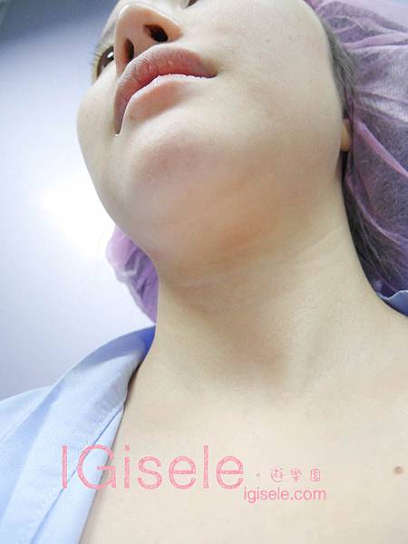 做了電波拉皮+音波拉皮 全臉跟眼週.眼皮鬆弛、法令紋下垂、雙下巴的人可以看這篇心得8.jpg 做了電波拉皮+音波拉皮 全臉跟眼週.眼皮鬆弛、法令紋下垂、雙下巴的人可以看這篇心得8.jpg