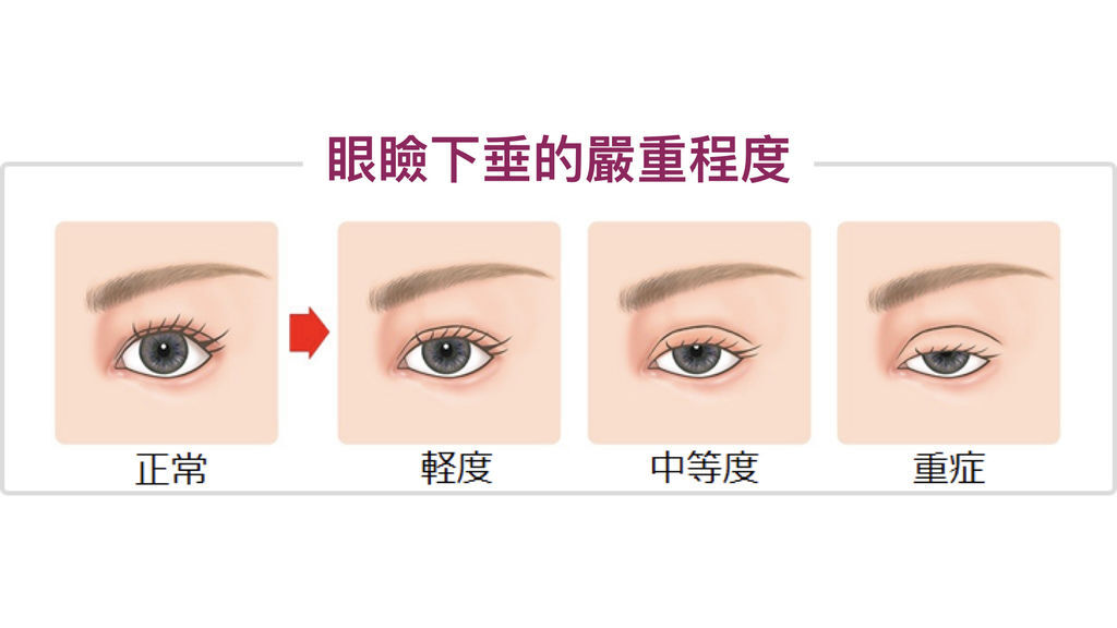 眼神放大提眼肌矯正術1