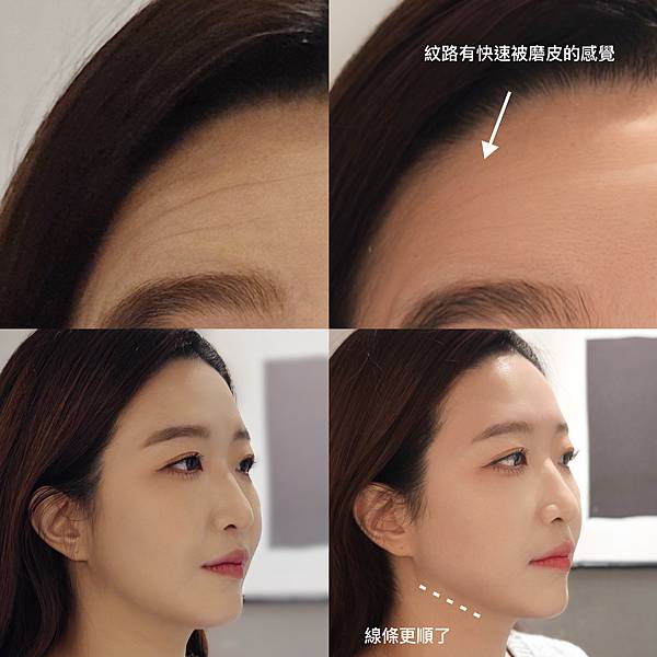 開年到「恆美學診所」的小巨蛋店,以天使肉毒來好好擺脫難纏的紋 開年到「恆美學診所」的小巨蛋店,以天使肉毒來好好擺脫難纏的紋